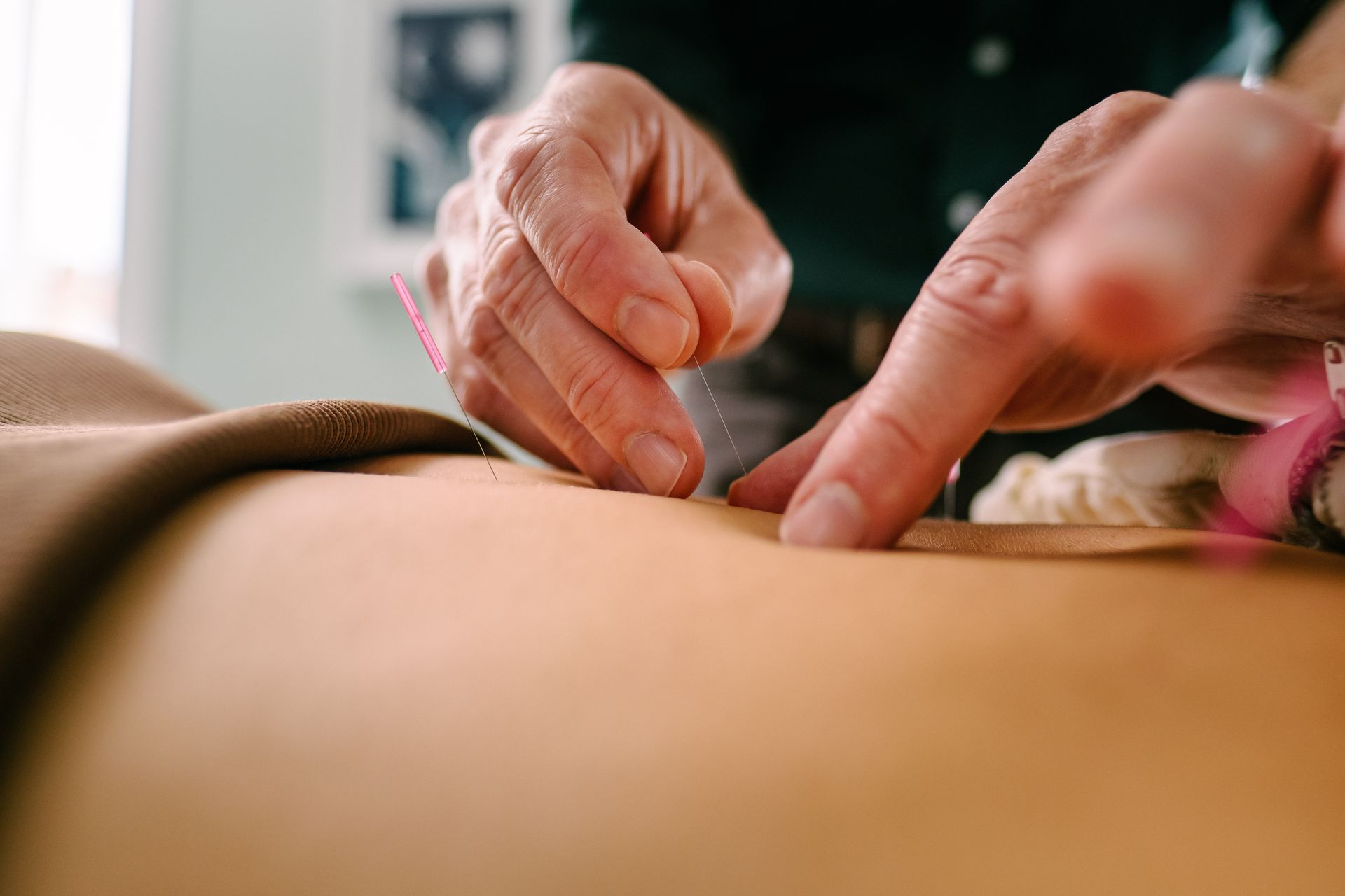 Acupuncture treatment session