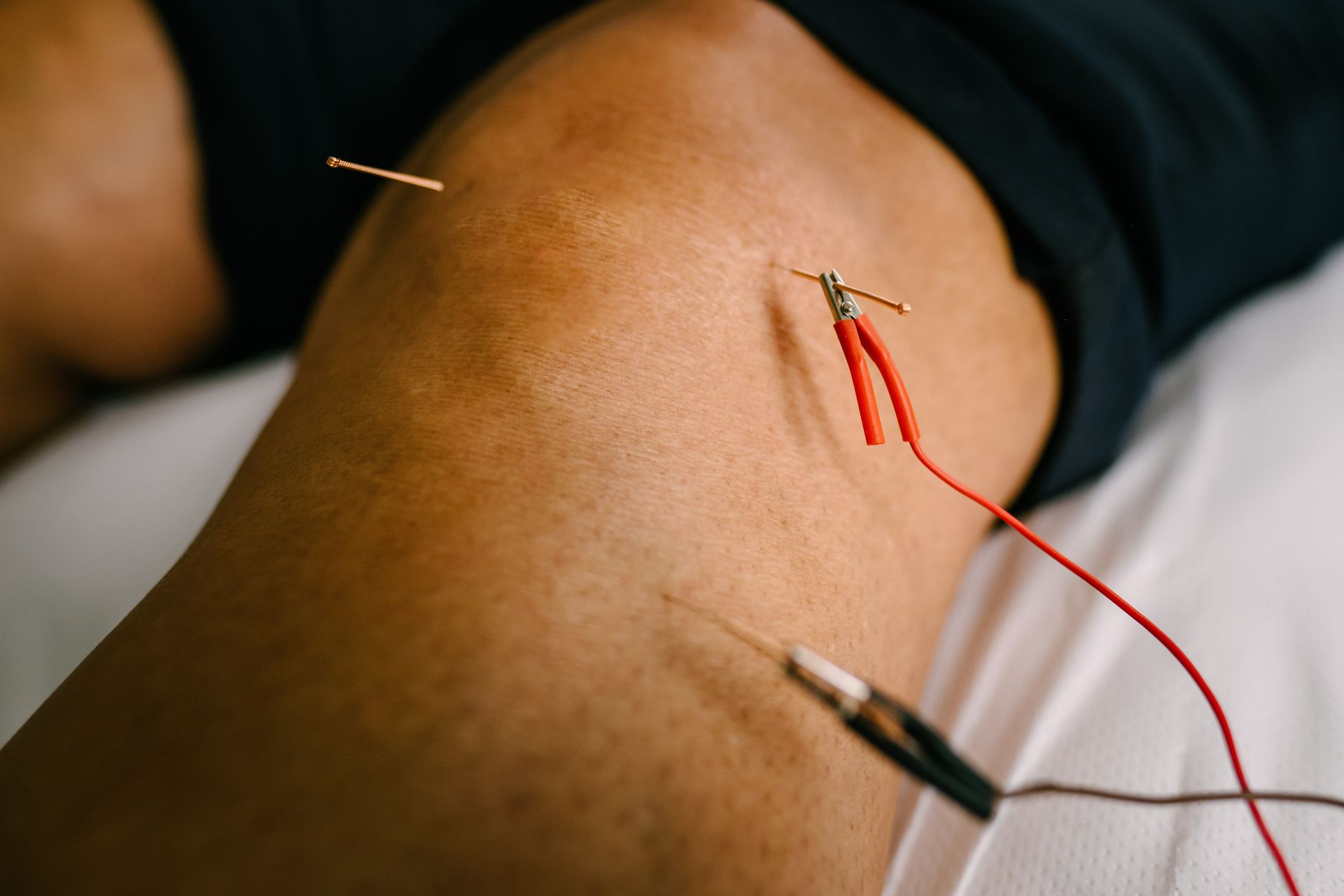 Electroacupuncture